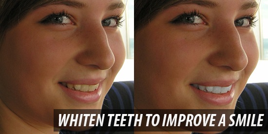 Whiten Teeth to Improve a Smile in Photoshop