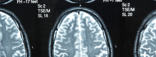 Axial MRI brain scan images showing detailed brain structures.