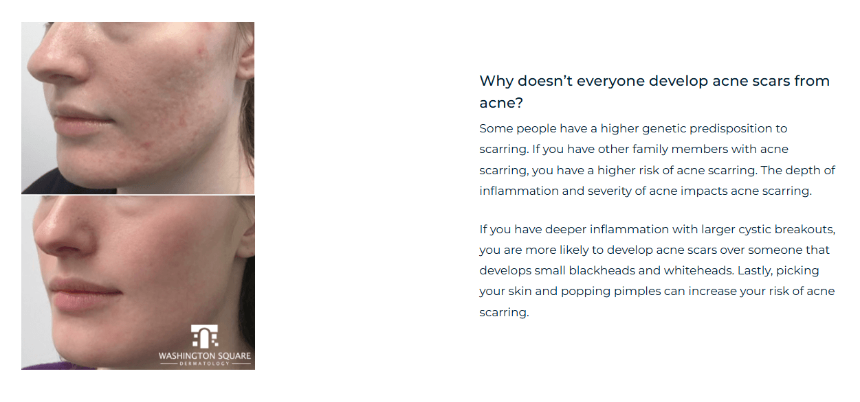 Example of a before-and-after photo of acne scar treatment from the dermatology practice