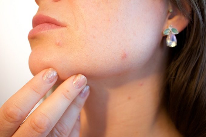 Close-up of a person's lower face and neck, showing their hand touching their chin with visible acne on the skin.