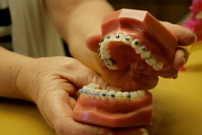 Hands holding a dental model with orthodontic braces on the teeth.