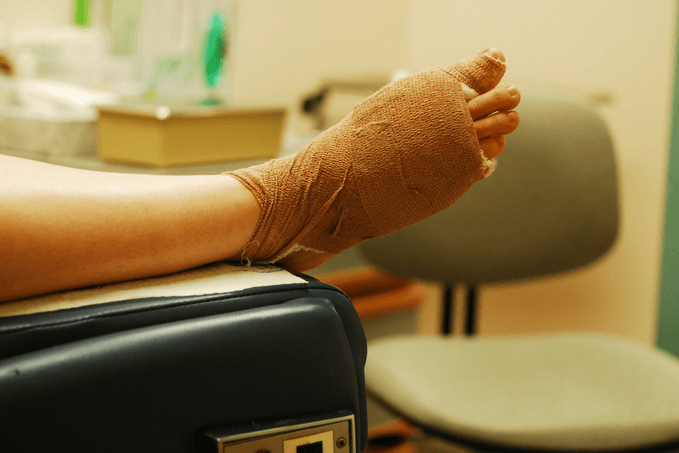 An arm with a brown medical bandage on the hand and wrist, resting on a black examination table in a clinical setting.